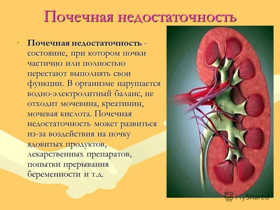 Общее заболевание почек. Почечная недостаточность патология. Заболевания мочевыделительной системы мочекаменная болезнь. Презентация на тему почки. Заболевание почек почечная недостаточность.