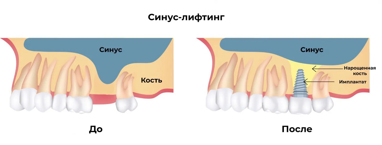 Открытый синус-лифтинг наращивание костной ткани. Синус-лифтинг закрытый, наращивание костной ткани. Синус лифтинг это наращивание костной ткани. Синус лифтинг верхней челюсти и имплант.
