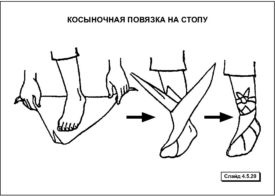 Какая повязка накладывается при повреждении голеностопного сустава. Косыночная повязка на кисть и стопу. Вывих плеча Косыночная повязка. Косыночная повязка на стопу и голеностопный сустав восьмерка. Косыночная повязка на локтевой сустав алгоритм.