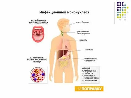 Температура при мононуклеозе у детей сколько
