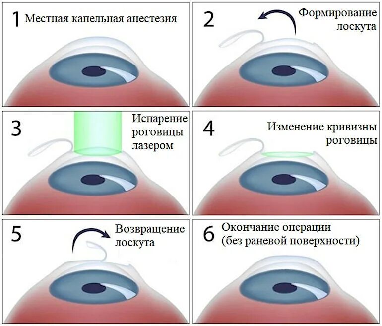 До какого возраста можно делать лазерную коррекцию. До какого возраста можно делать лазерную коррекцию