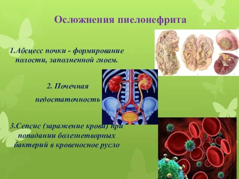 Осложнения хронического пиелонефрита. Профилактика острого пиелонефрита. Осложнения острого пиелонефрита. Осложнения пиелонефрита у детей.