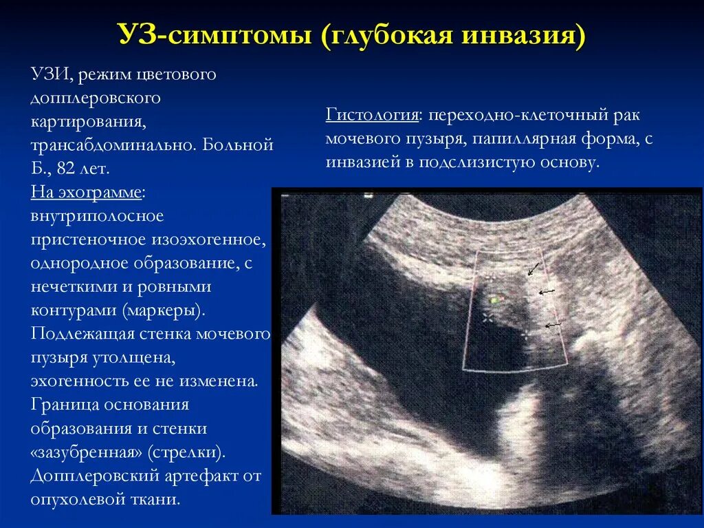 Образования мочевого пузыря на УЗИ. УЗИ мочевого пузыря на УЗИ.