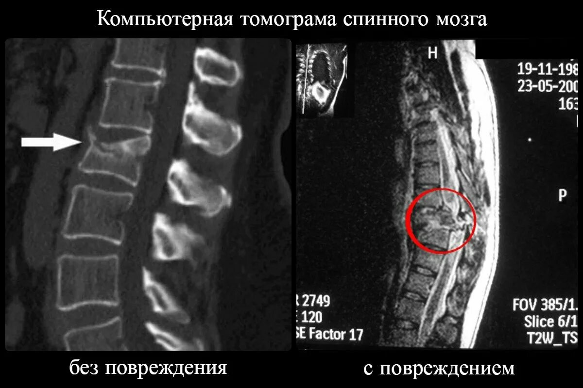 Закрытый перелом спинного мозга