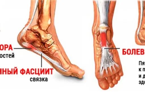 Пяточная шпора проходит сама по себе. Подошвенная шпора стопы.