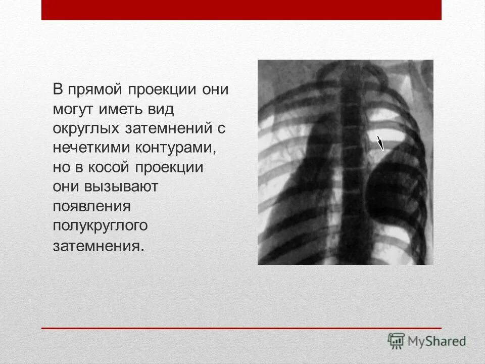 Виды затемнения в легких. Нечеткие контуры ограниченного затемнения легкого. Участок затемнения с четкими. Участки линейного затемнения. Округлое затемнение