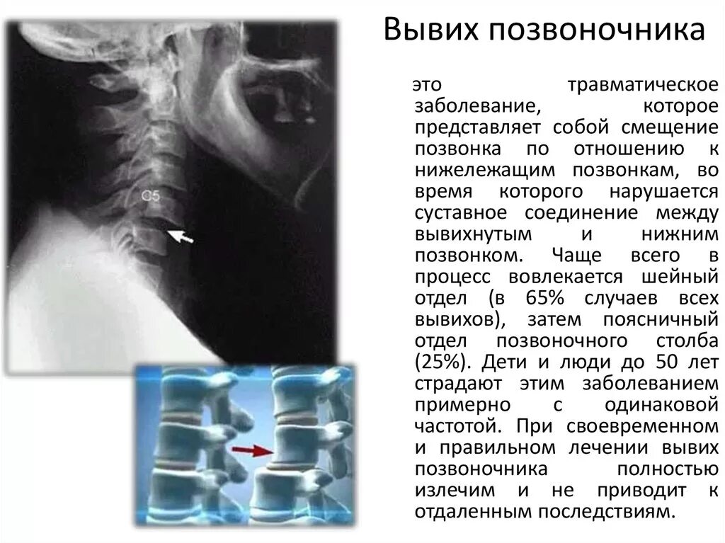 Локальный статус позвоночник. Подвывих с1 шейного позвонка рентген. Подвывих шейного отдела позвоночника. Подвывих с6 позвонка. Вывих позвонка шейного отдела с 2.