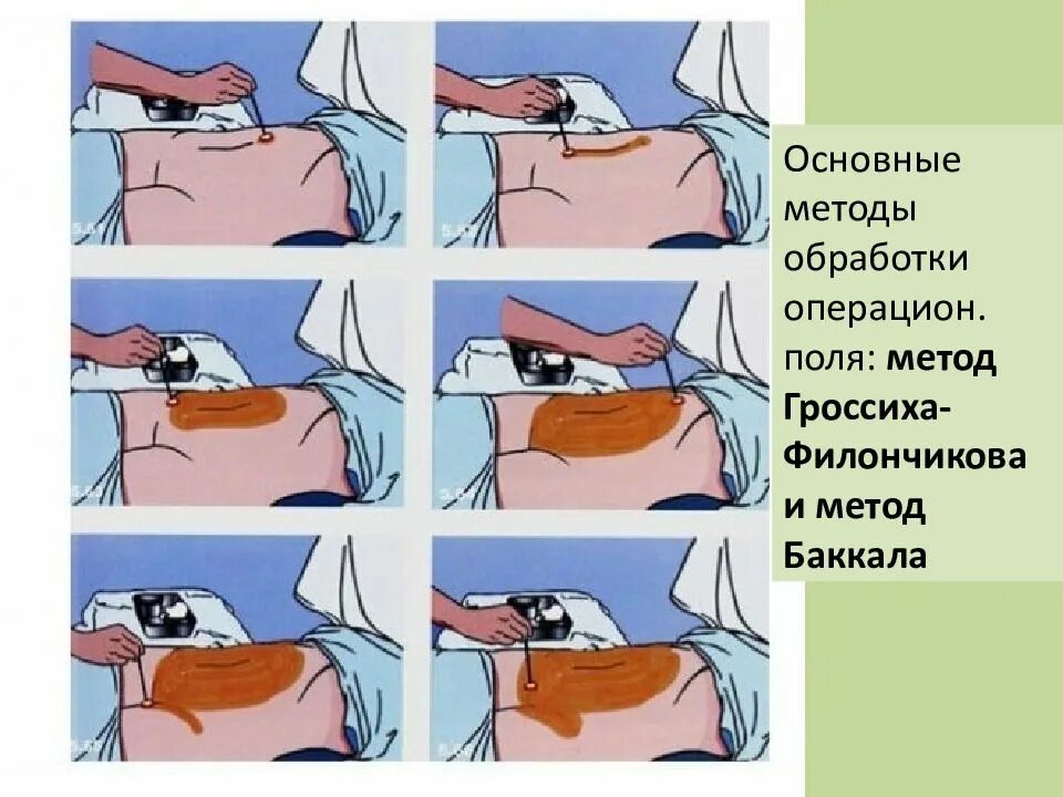 Алгоритм операционного поля. Обработка операционного поля алгоритм. Обработка операционного поля по Гроссиху-Филончикову. Способ Гроссиха Филончикова обработка операционного поля. Методика обработки операционного поля по Гроссиху – Филончикову.