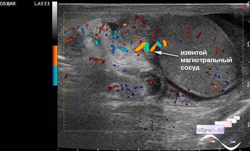 Воспаление семенного канатика у мужчин. Воспаление семенного канатика на УЗИ. Семенной канатик на УЗИ мошонки.