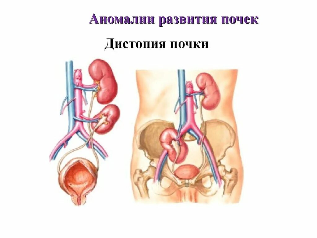 Аномалии развития мочеполовой. Аномалии развития почек и верхних мочевых путей. Врожденные пороки развития мочевыделительной системы. Аномалии расположения почек дистопия. Нефроптоз дистопия почки.