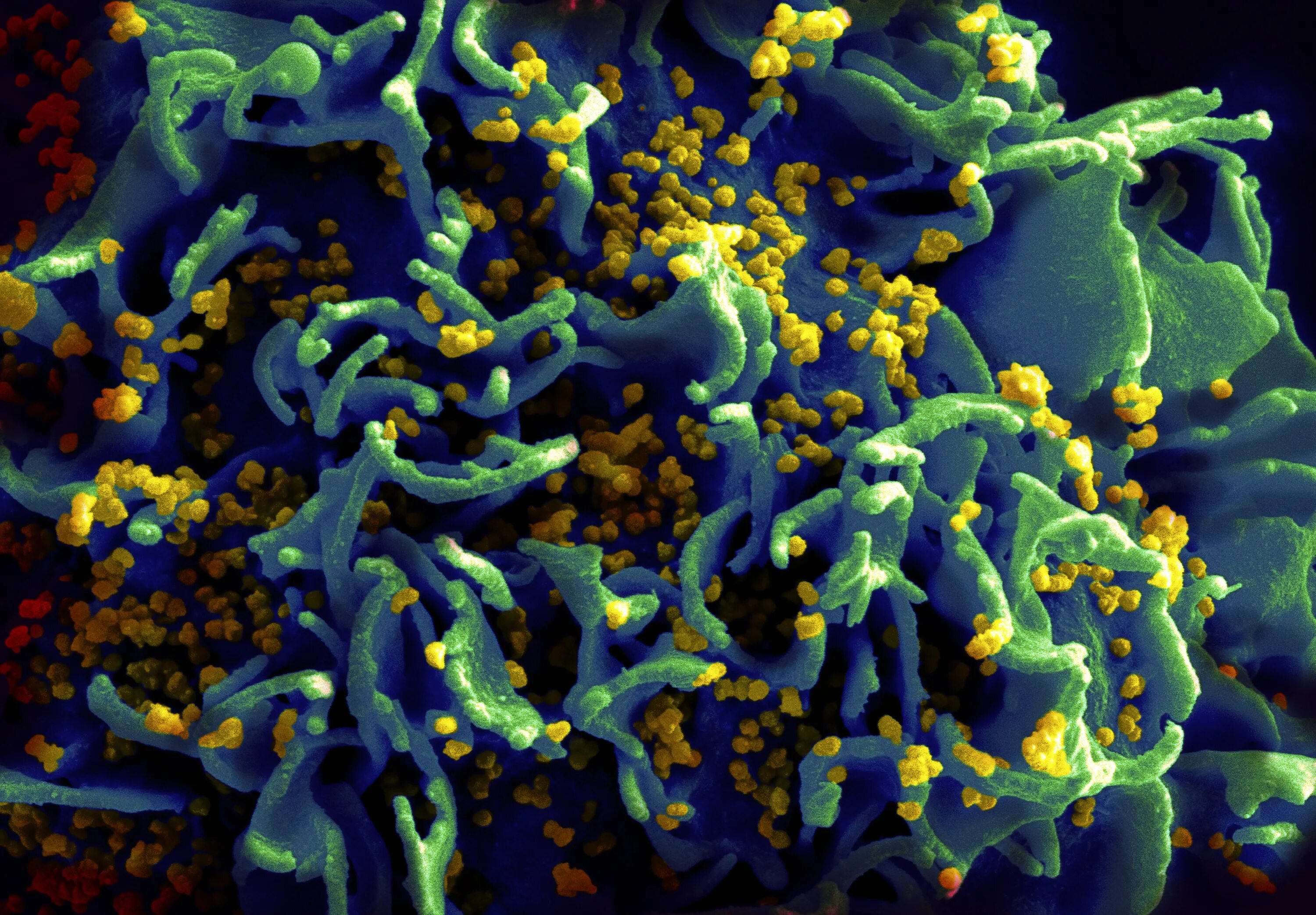 Вирус ВИЧ под микроскопом. СПИД бактерия. Инфекции под микроскопом.