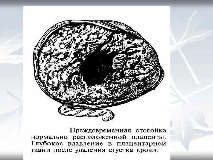 Как выглядит отслойка. Преждевременная отслойка. преждевременная отслойка плаценты.
