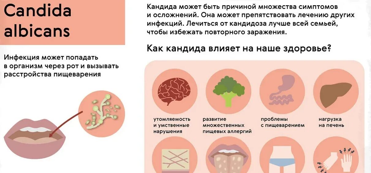 Кандидоз у женщин причины. Молочница у женщин симптомы.