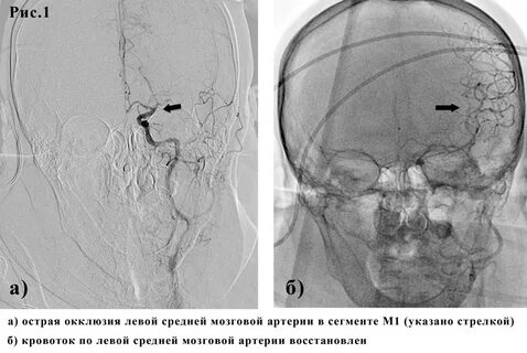 Окклюзия сонной