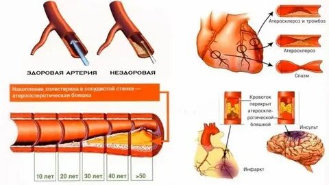 Сильнейший атеросклероз