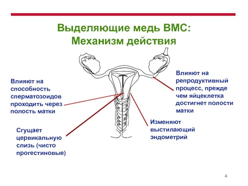 Схема вмс. Механизм внутриматочной спирали. внутриматочная спираль механизм действия. механизм действия противозачаточные спирали. механизм действия вмс спирали.