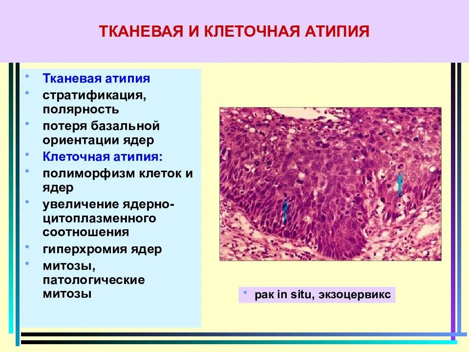 Клеточная атипия. Клеточная и ядерная атипия. Признаки тканевой атипии. Отсутствуют клетки с признаками атипии