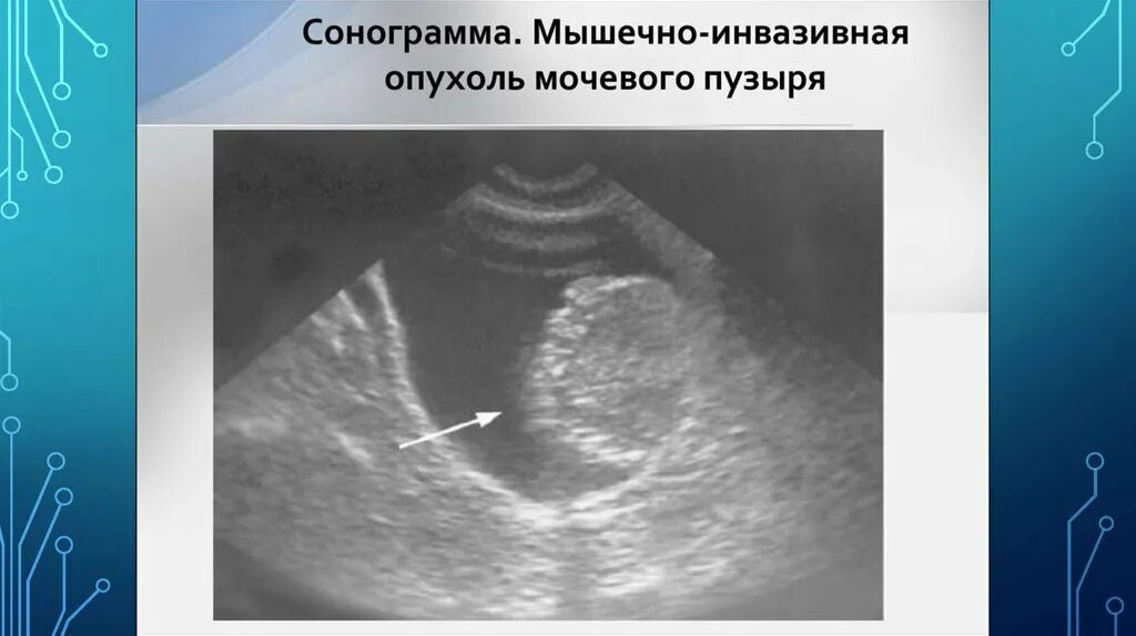 Мочевой рецидив. Опухоль мочевого пузыря сонограмма. Объемное образование мочевого пузыря. Доброкачественная опухоль мочевого пузыря на УЗИ. Образования мочевого пузыря на УЗИ.