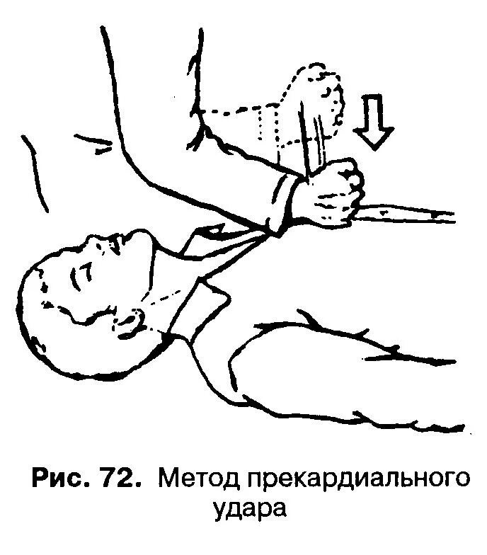 Прекардиальный удар при оказании 1 помощи. Нанесение прекардиальный удар. Провжеение прекарщиального удара. Место нанесения прекардиального удара. Прекардиальный удар при оказании первой.