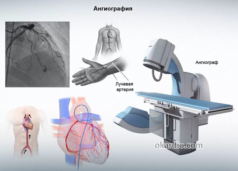 Селективная коронарная ангиография. Коронарография лучевая Вена. Рентгеноконтрастная коронарография. Ангиография коронарных сосудов.