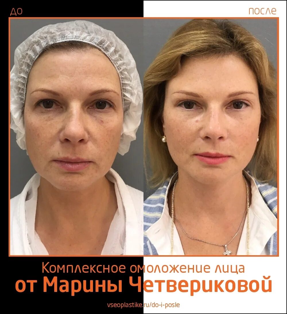 Подтяжка лица отрицательные отзывы. Подтяжка лица отрицательные отзывы. Ультразвуковая подтяжка ultherapy. Подтяжка лица отрицательные отзывы. Смас лифтинг подтяжка лица отзывы.
