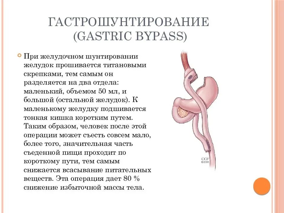 Гастрошунтирование желудка схема операции. Бариатрическая операция гастрошунтирование. Желудочное шунтирование схема операции. Бариатрическая операция шунтирование желудка.