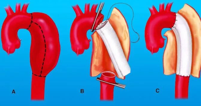Протез восходящей аорты и аортального клапана. Аневризматическое расширение корня аорты и восходящего отдела аорты. Эндопротезирование дуги аорты. Дилатация восходящего отдела аорты. Аневризма восходящей аорты операция