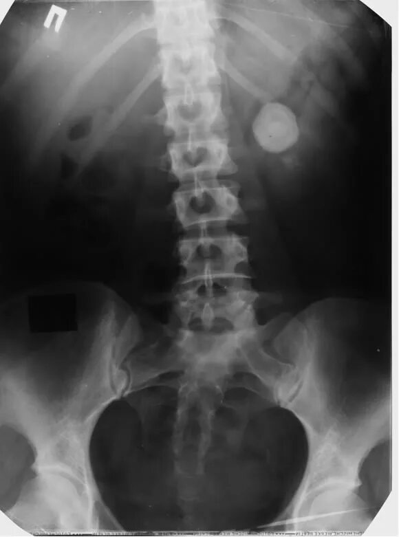 Мочекаменная болезнь мочеточника. Обзорная урограмма мочекаменная болезнь. Экскреторная урография камень мочеточника. Обзорная урография камень мочеточника. Обзорная урография рентген.