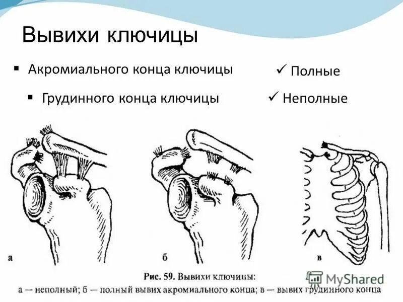характерные симптомы вывиха акромиального конца ключицы:. подвывих акромиально-ключичного сочленения рентген. перелом ключицы, вывих акромиального конца rentgen. классификация разрывов плечевого суставов. подвывих акромиального конца ключицы операция.