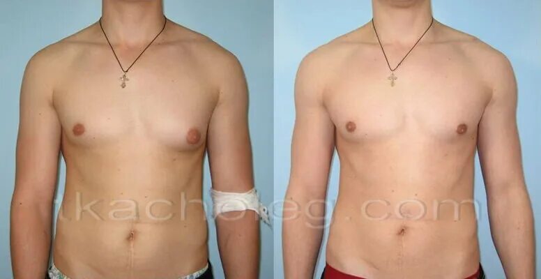 пролактинома гинекомастия. милованов гинекомастия. нормальная мужская грудь. фиброзная гинекомастия. формы сосков.