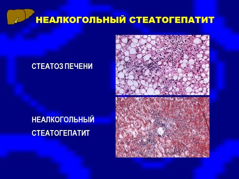 Признаки стеатоза печени. Стеатоз печени гистология. Степень стеатоза печени s3. Стеатогепатоз печени (к-86.1).