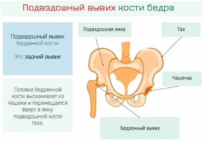 Лобковая область мужчины. Механизм вывиха тазобедренного сустава. Вывих кости в тазобедренном суставе. Реабилитация головки бедренной кости. Дисплазия вертлужной впадины тазобедренного сустава.