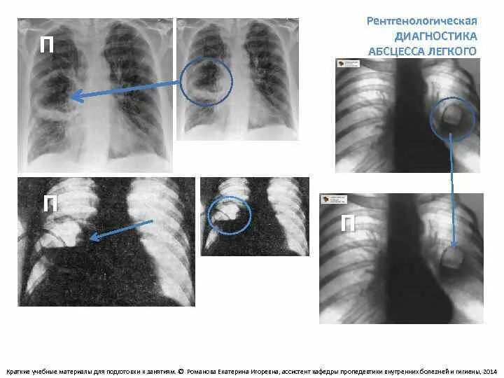 Диагноз абсцесс легкого. Абсцесс легкого диагностика. Абсцесс легкого дифференциальная диагностика. Абсцесс легкого диагноз. Абсцесс легкого рентген дифференциальная диагностика.