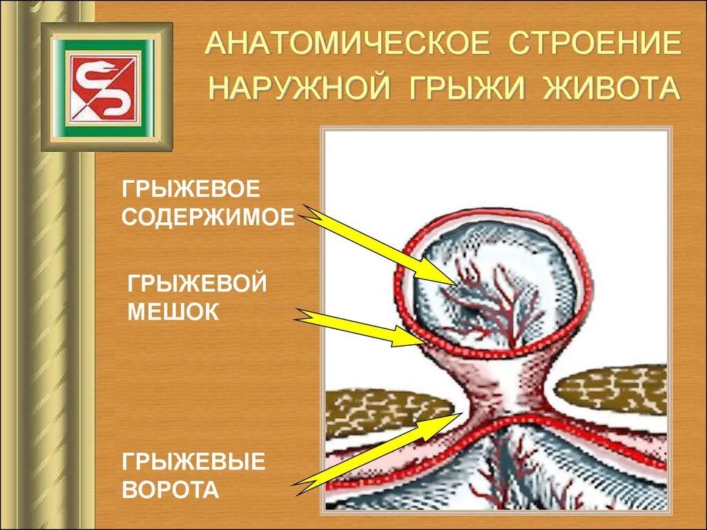 Стенка грыжевого мешка. Строение стенки грыжевого мешка. строение пупочной грыжи.