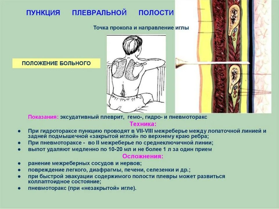Техника выполнения плевральной пункции. Плеаральная пкнквия методика. Техника проведения пункции плевральной полости. Техника плевральной пункции при гидротораксе. Методика выполнения пункции плевральной полости.