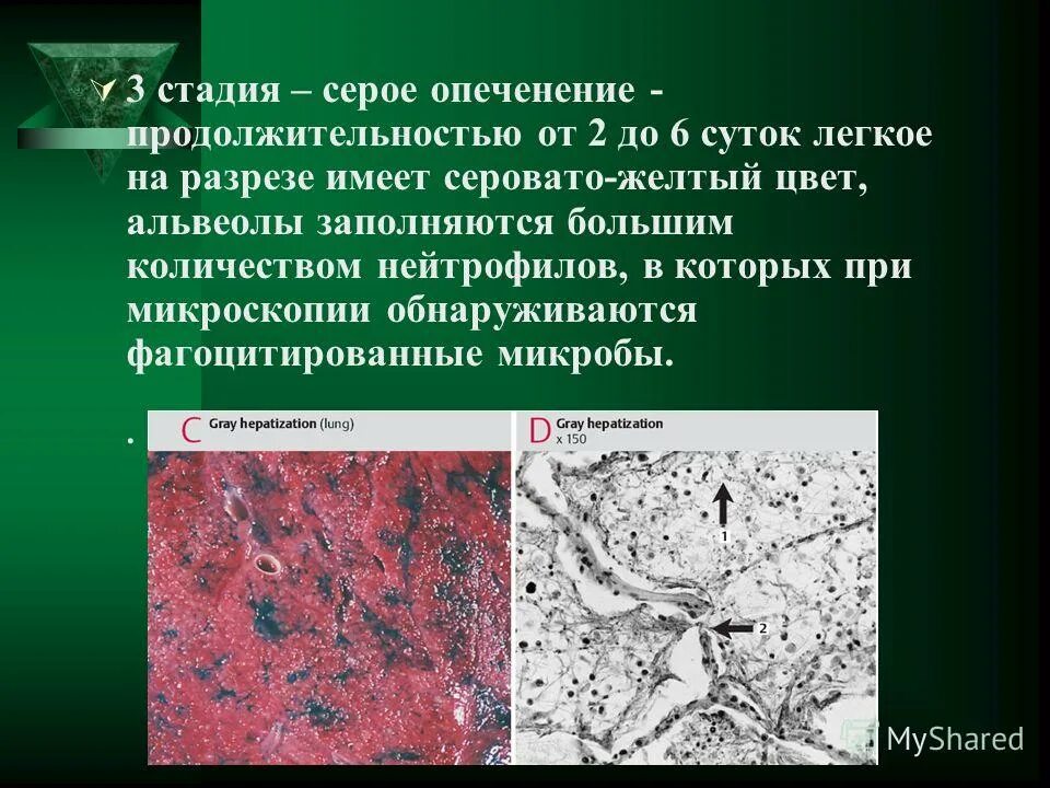 стадия опеченения при долевой пневмонии. серое опеченение крупозной пневмонии. серое опеченение крупозной пневмонии макропрепарат. стадия красного опеченения при крупозной пневмонии микропрепарат. серое опеченение пневмония макропрепарат.