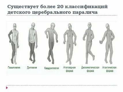 Клинические формы дцп