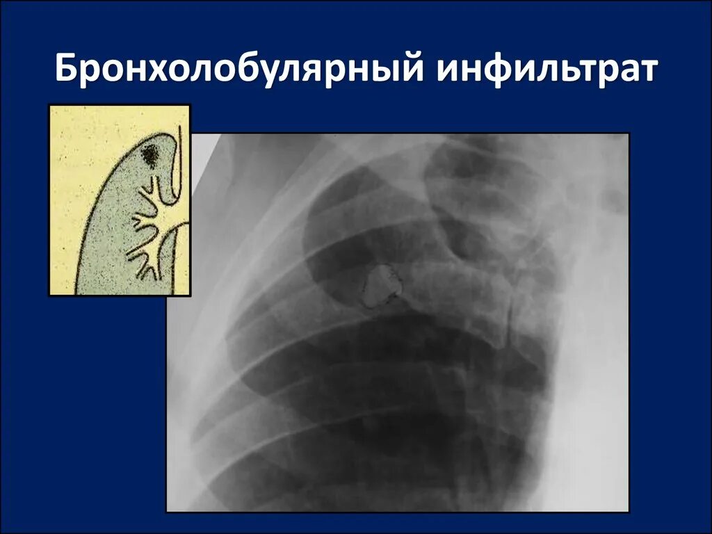 Синдром инфильтрата