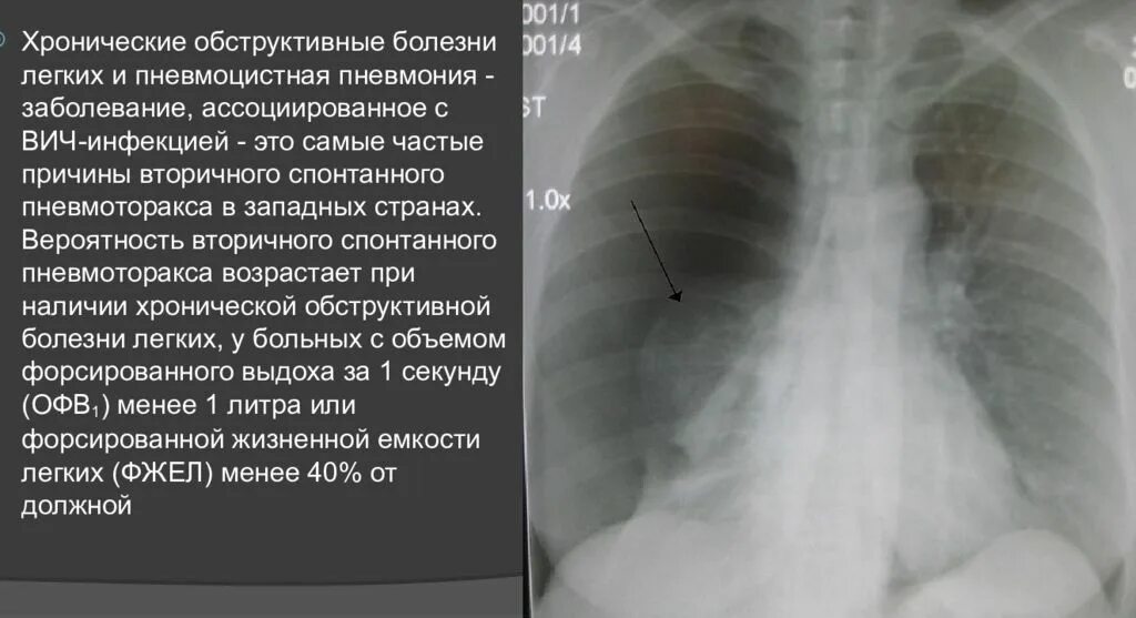 Коллабированное легкое при пневмотораксе