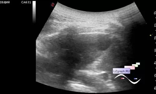 Кальцинат в печени на узи. Мультилокулярная киста почки на УЗИ. Подкапсульная киста почки на УЗИ. Простая киста почки УЗИ.