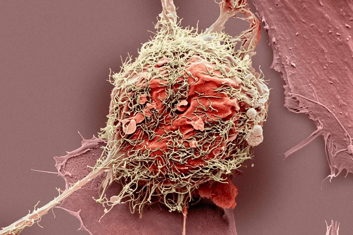 Злокачественная опухоль. Раковые клетки микроскоп. Клетки злокачественной опухоли. Раковые клетки микрофотографии. Раковая опухоль злокачественная под микроскопом.