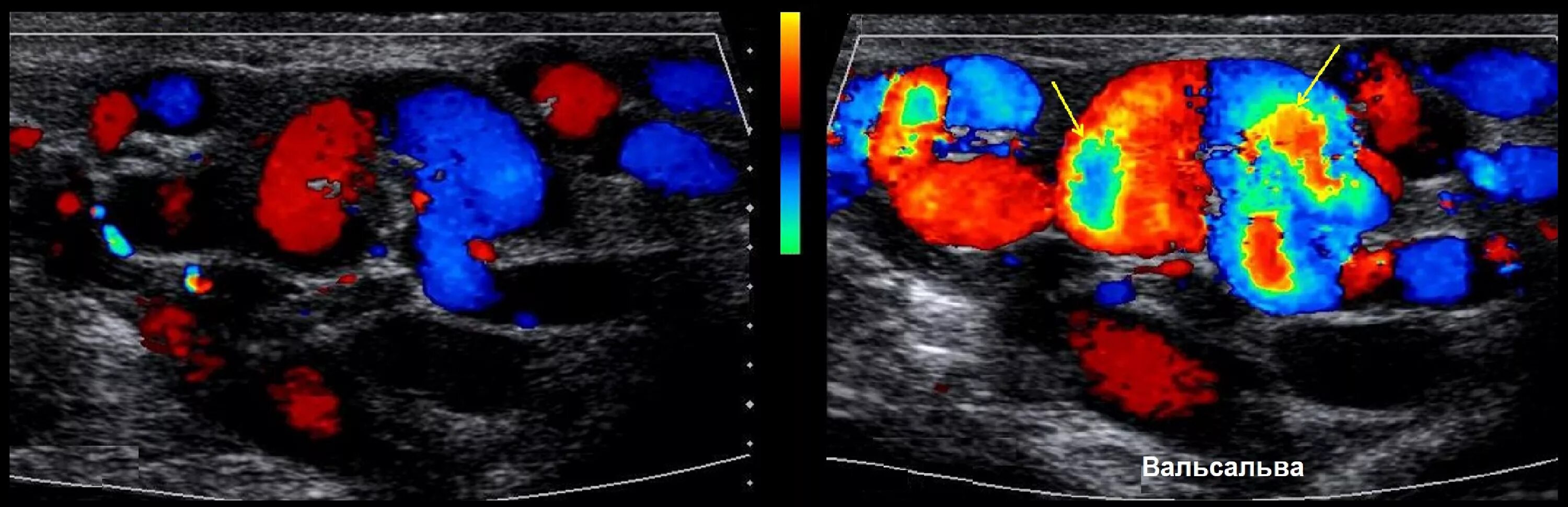 Расширение вен канатика. УЗИ при варикоцеле 3 степени. Варикозное расширение вен семенного канатика на УЗИ. Вены семенного канатика норма УЗИ. Проба Вальсальвы УЗИ.