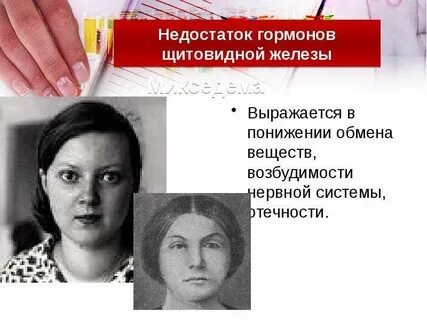 Микседема при гипотиреозе