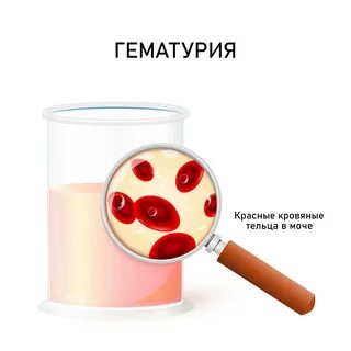 Гематурия общий анализ мочи
