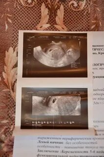 Тянут яичники после овуляции форум