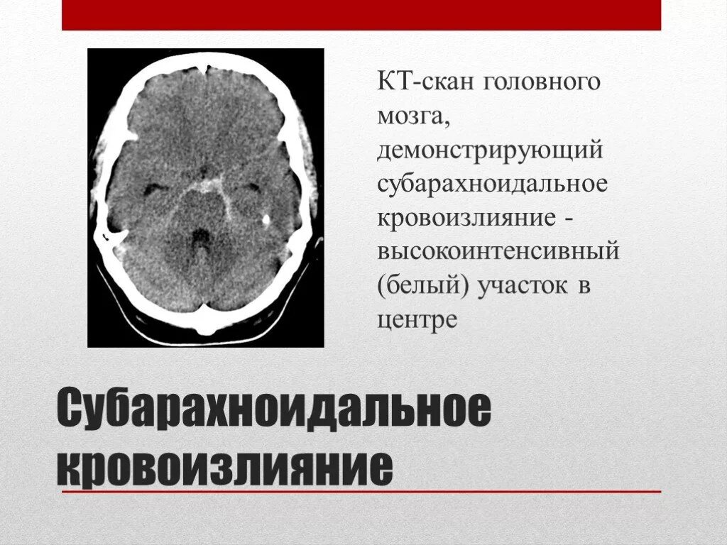 Геморрагический инсульт субарахноидальное кровоизлияние кт. Субарахноидальный инсульт кт. Субарахноидально-паренхиматозное кровоизлияние кт. Субархноидальное кров. Травматическое кровоизлияние