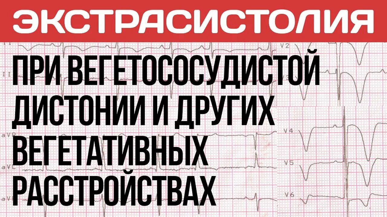 Всд вахта. ЭКГ при вегетососудистой дистонии. Экстрасистолия при ВСД. Кардиограмма при ВСД. Экстрасистолы и панические атаки.