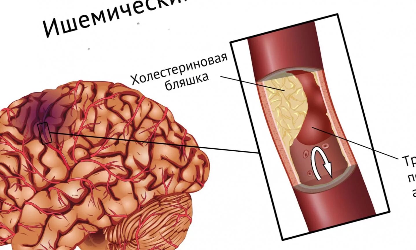 Ишемический эмболический инсульт. Ишемический инсульт поражения артерий. Ишемический инсульт рисунок. Картинки на тему инсульт. Что такое ишемический инсульт головного мозга