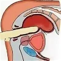 Давит на простату. Ректальное исследование предстательной железы. Пальцевое исследование прямой кишки. Пальцевое ректальное исследование простаты. Пальцевое ректальное исследование прямой кишки.