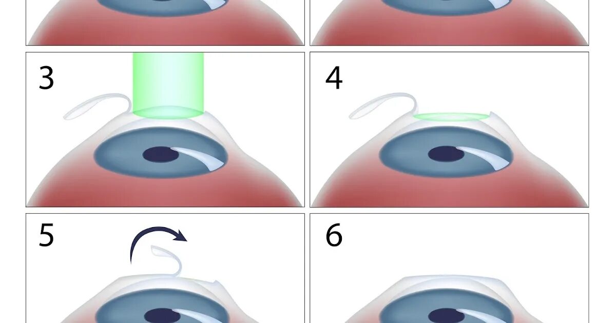 Лазерная коррекция зрения ласик. Лазерная операция на глаза Фемто ласик. Лазерная коррекция методом Фемто ласик. Этапы операции super LASIK.